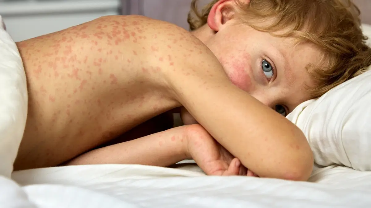 Global Measles Cases Surge as Vaccination Gaps Trigger Fresh Public Health Concern
