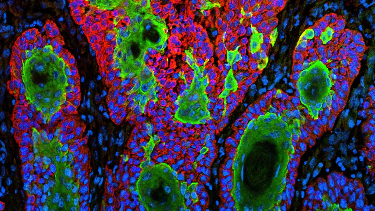 Replimune Skin Cancer Therapy Fails to Secure US FDA Approval Again