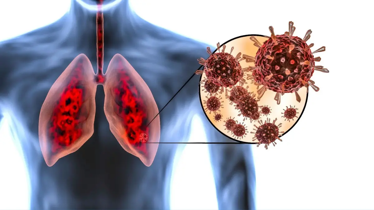 Study Links COVID-19 Lung Damage to Increased Long-Term Cancer Risk
