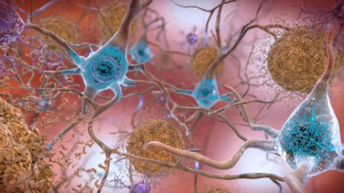 Review Finds Alzheimer’s Drugs Show No Significant Benefit for Patients
