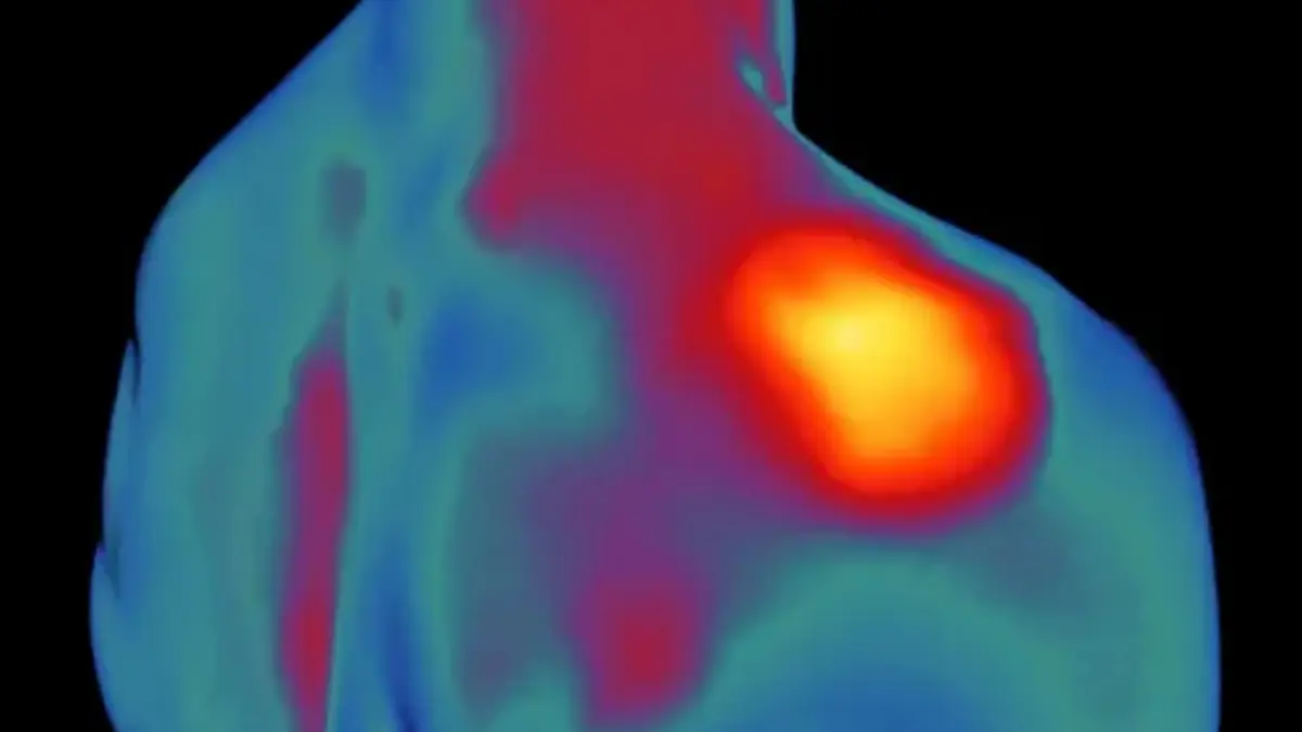 Stiff person syndrome drug breakthrough Restores Mobility