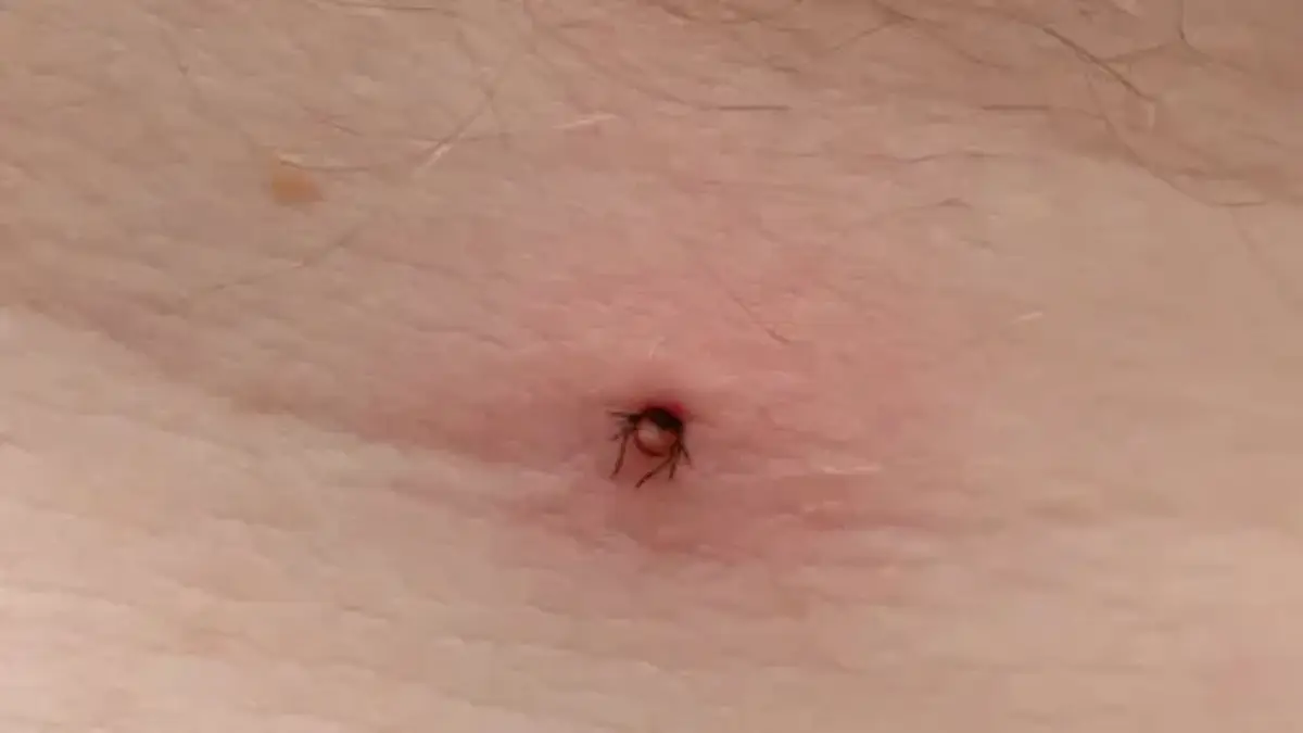 Lyme Disease Vaccine Breakthrough Could Stop Ticks Infection