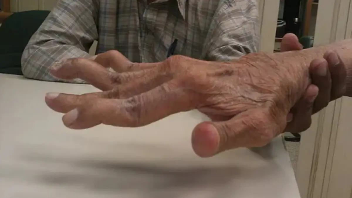 Arthritis Ageing Joints Protein Breakthrough Could Reverse Damage