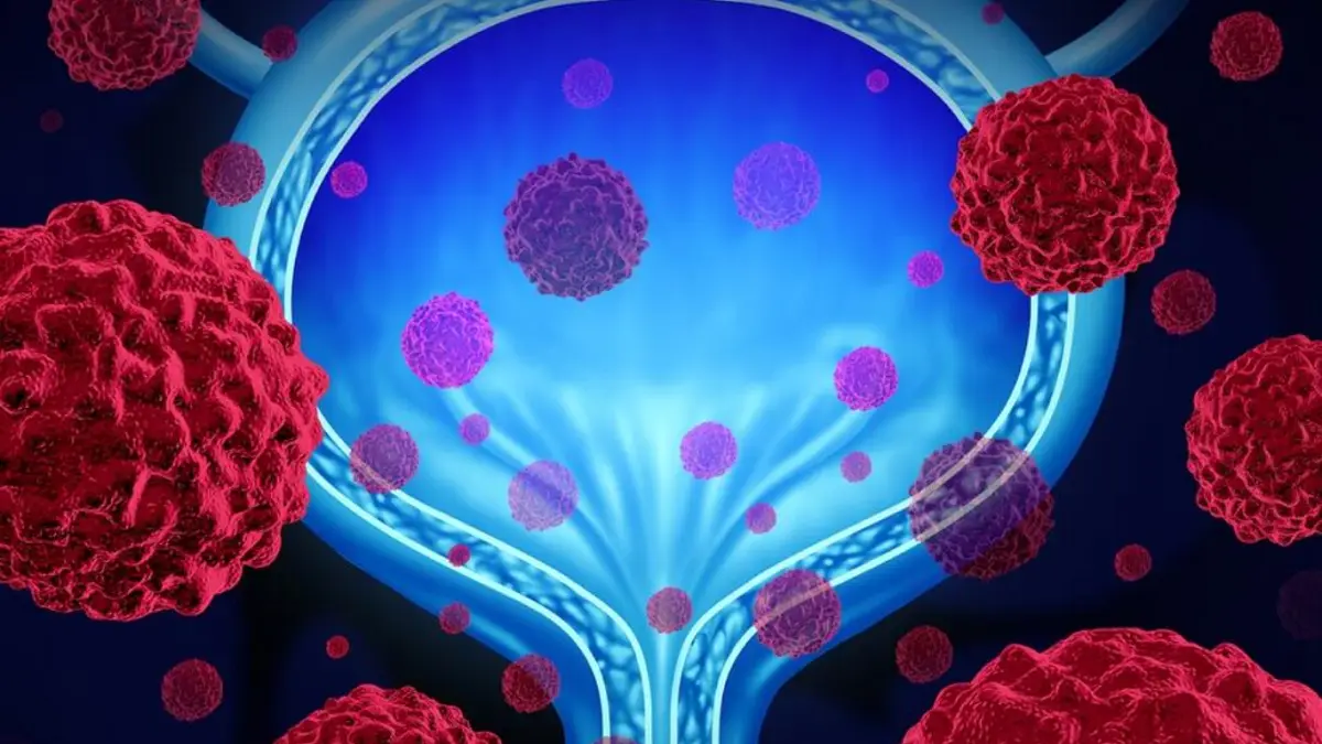 Bladder Cancer Research Advances Highlight Birmingham Breakthrough