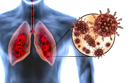 Study Links COVID-19 Lung Damage to Increased Long-Term Cancer Risk