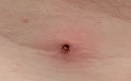 Lyme Disease Vaccine Breakthrough Could Stop Ticks Infection